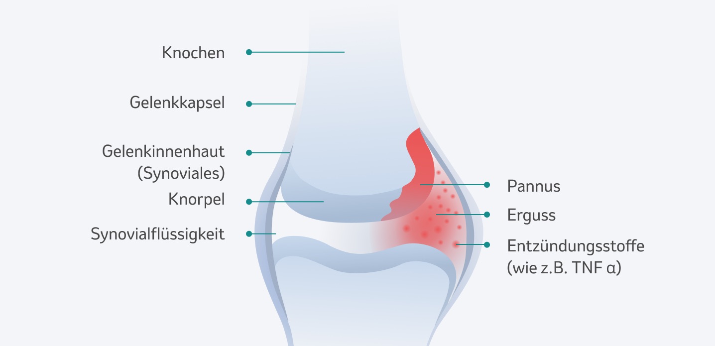 Veränderungen der Gelenke bei Arthritis